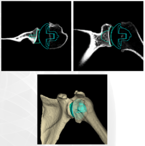 Abbildung 1 Dreidimensionale Planung einer anatomischen Schulterprothese