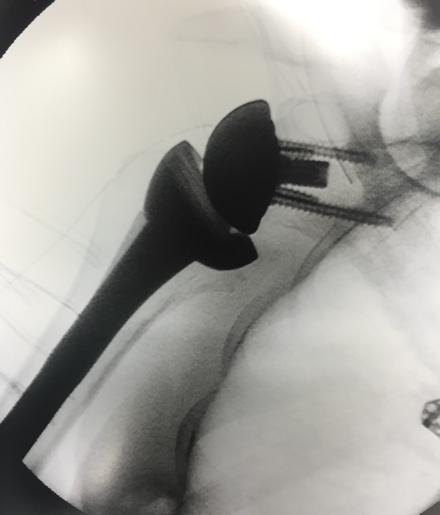 Abbildung 3 Röntgenbild einer inversen Schulterprothese